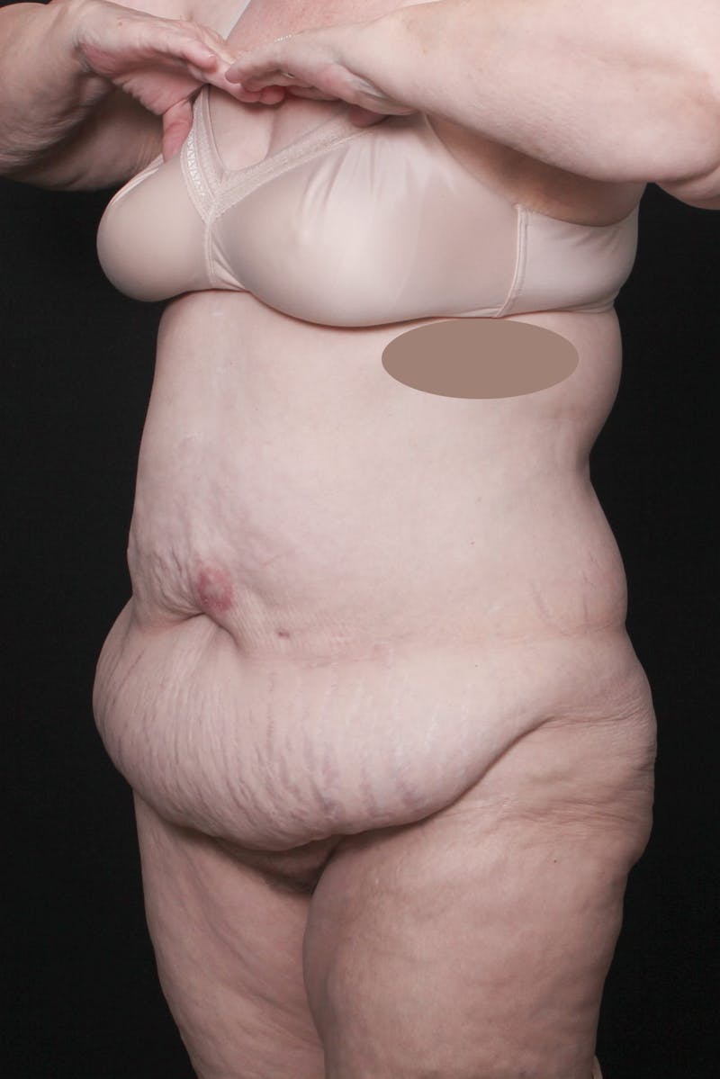 Fleur Di Lis Abdominoplasty Before & After Gallery - Patient 203316 - Image 9