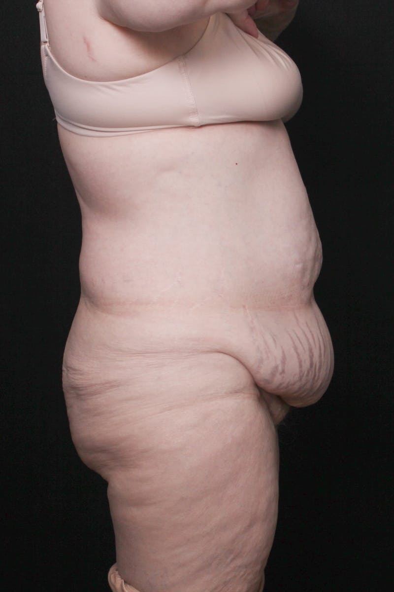 Fleur Di Lis Abdominoplasty Before & After Gallery - Patient 203316 - Image 3