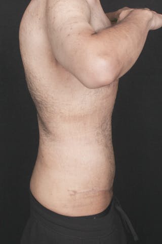 Fleur Di Lis Abdominoplasty Before & After Gallery - Patient 144795 - Image 10