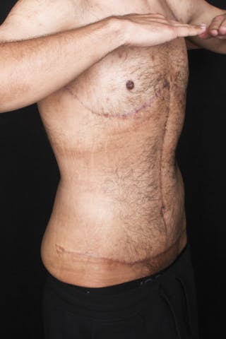 Fleur Di Lis Abdominoplasty Before & After Gallery - Patient 144795 - Image 4