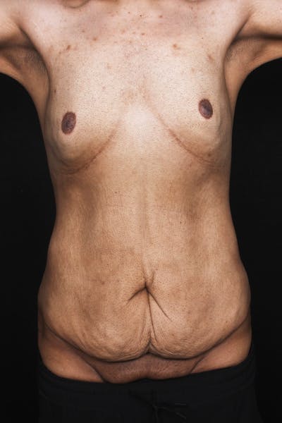 Fleur Di Lis Abdominoplasty Before & After Gallery - Patient 144795 - Image 1