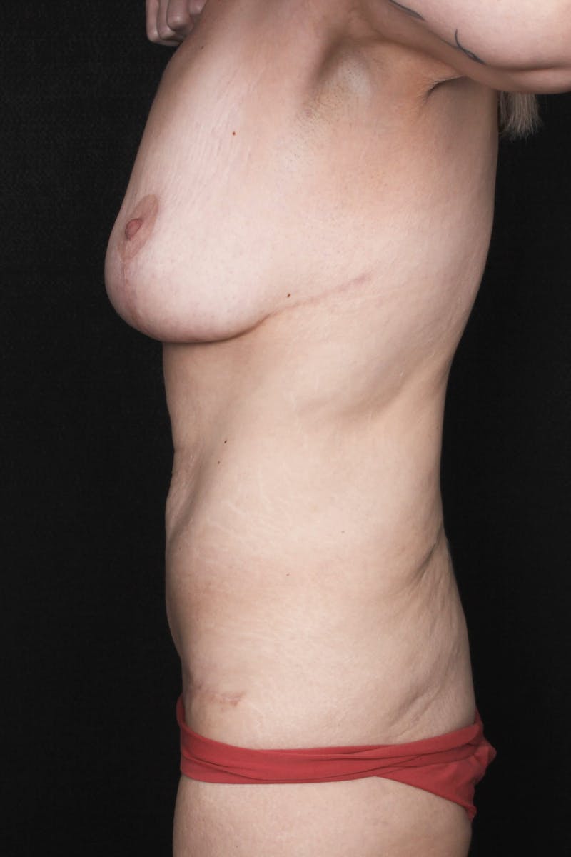 Fleur Di Lis Abdominoplasty Before & After Gallery - Patient 834715 - Image 6