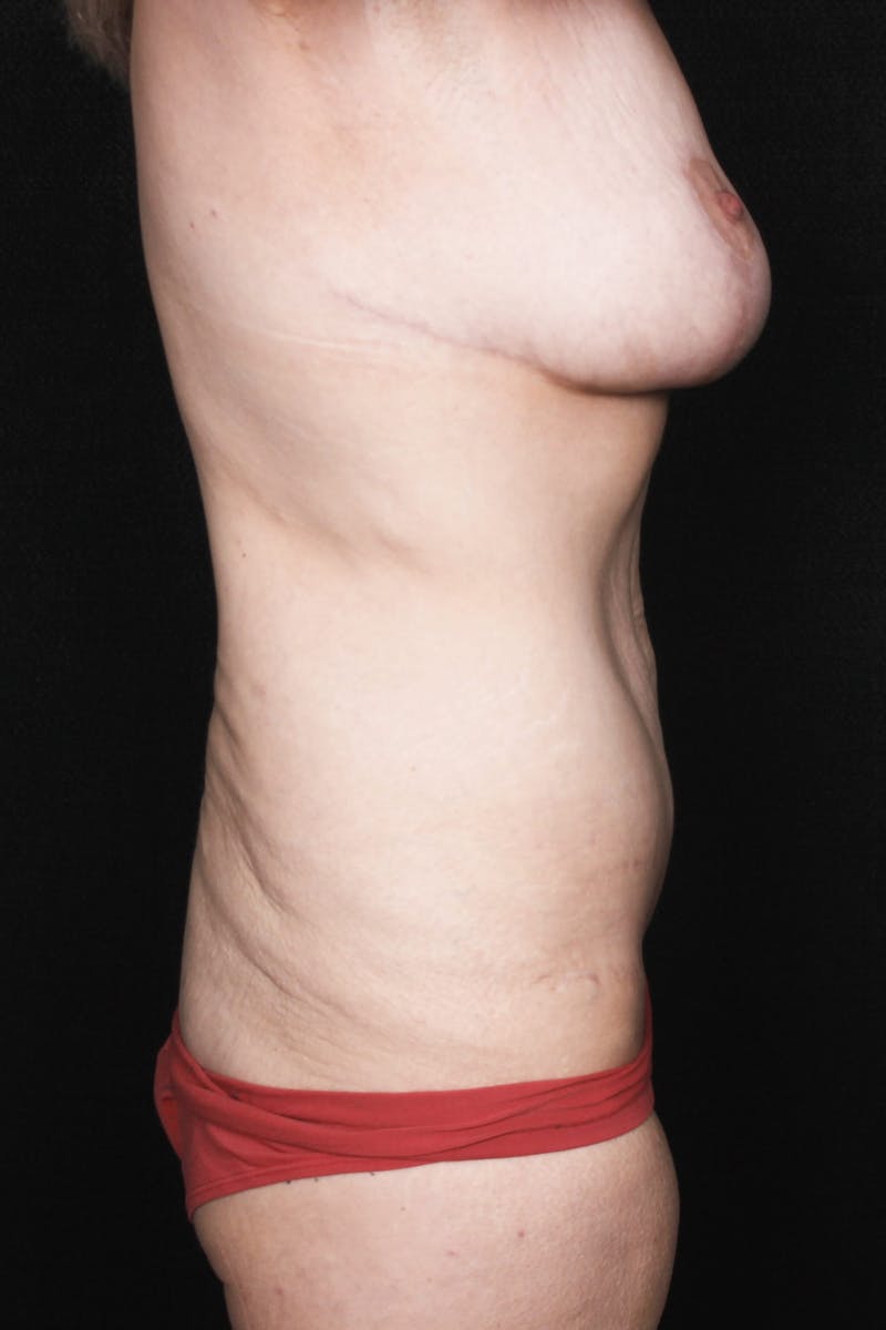 Fleur Di Lis Abdominoplasty Before & After Gallery - Patient 834715 - Image 8
