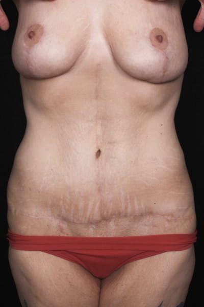 Fleur Di Lis Abdominoplasty Before & After Gallery - Patient 834715 - Image 2
