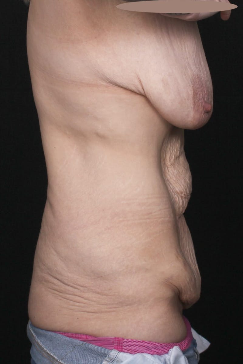 Fleur Di Lis Abdominoplasty Before & After Gallery - Patient 834715 - Image 7