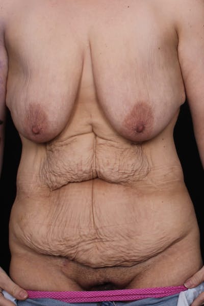 Fleur Di Lis Abdominoplasty Before & After Gallery - Patient 834715 - Image 1