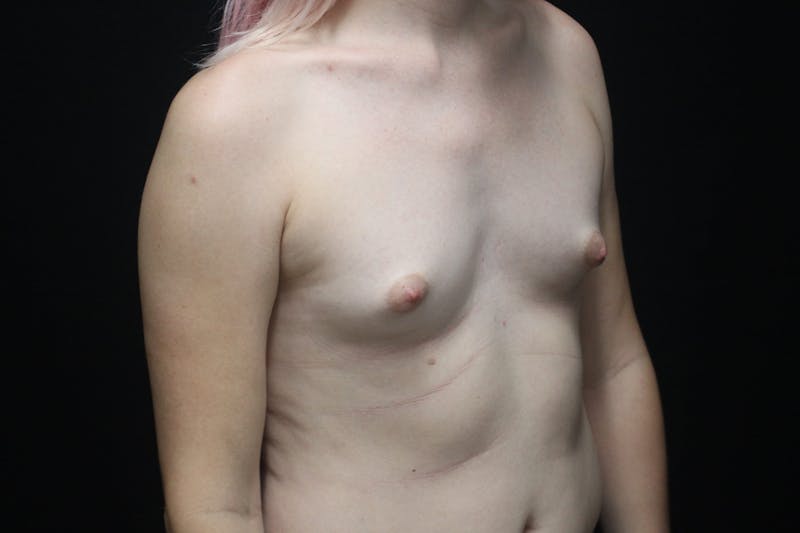 MTF Breast Augmentation Before & After Gallery - Patient 144617 - Image 5