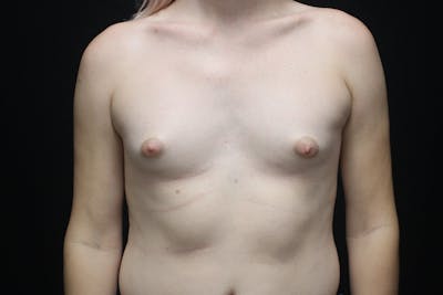 MTF Breast Augmentation Before & After Gallery - Patient 144617 - Image 1