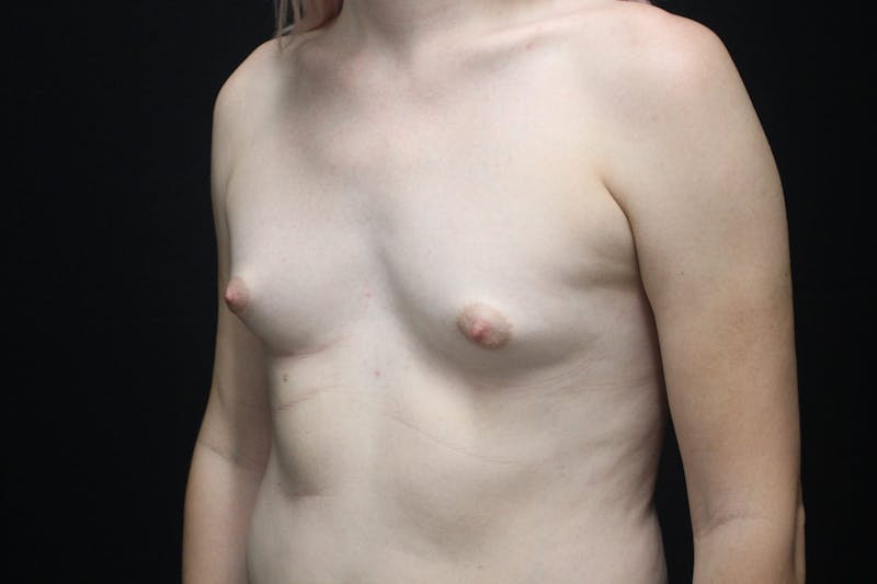 MTF Breast Augmentation Before & After Gallery - Patient 144617 - Image 3