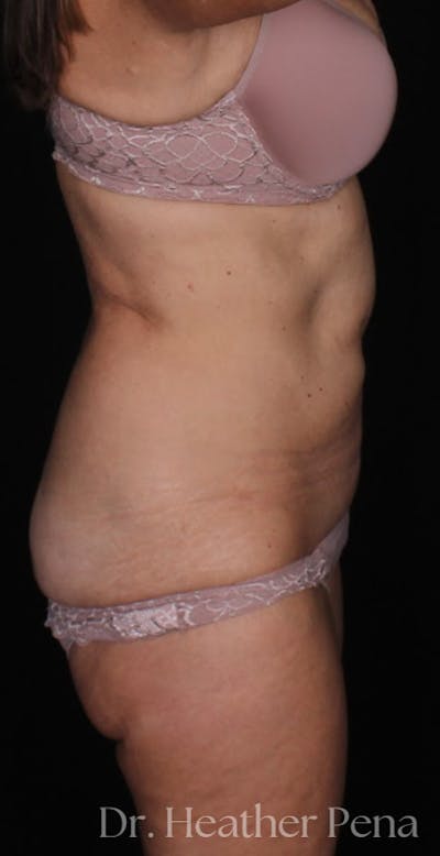 Abdominoplasty Before & After Gallery - Patient 319384 - Image 1