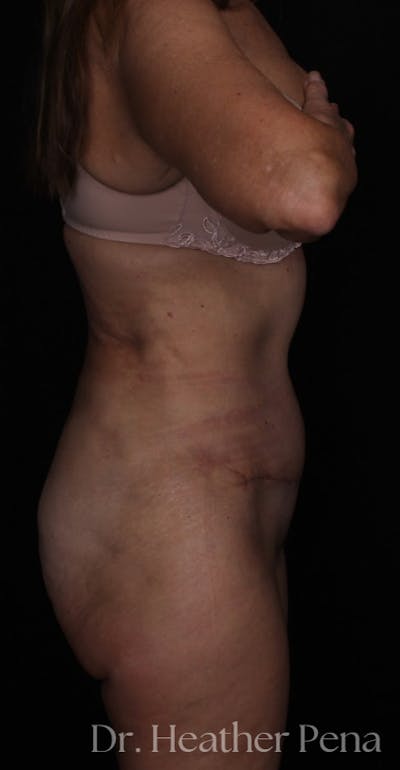 Abdominoplasty Before & After Gallery - Patient 319384 - Image 2