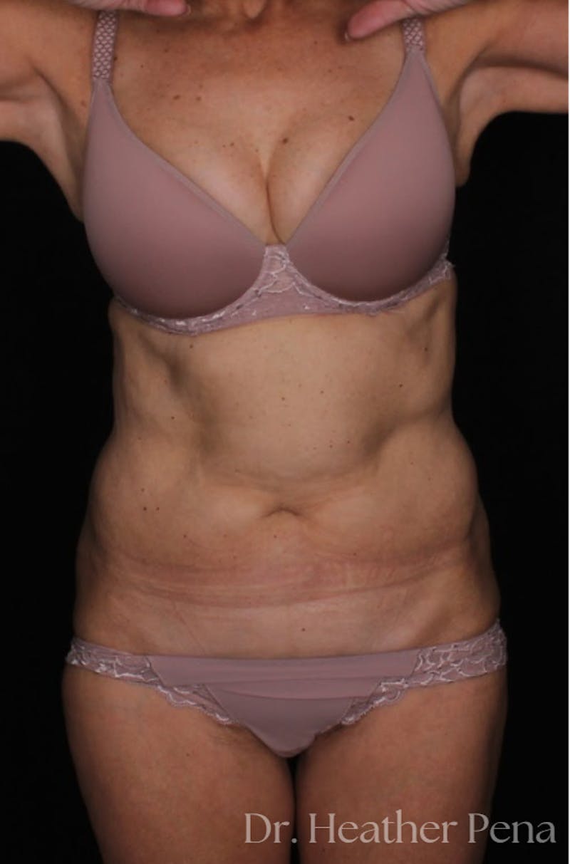 Abdominoplasty Before & After Gallery - Patient 319384 - Image 3