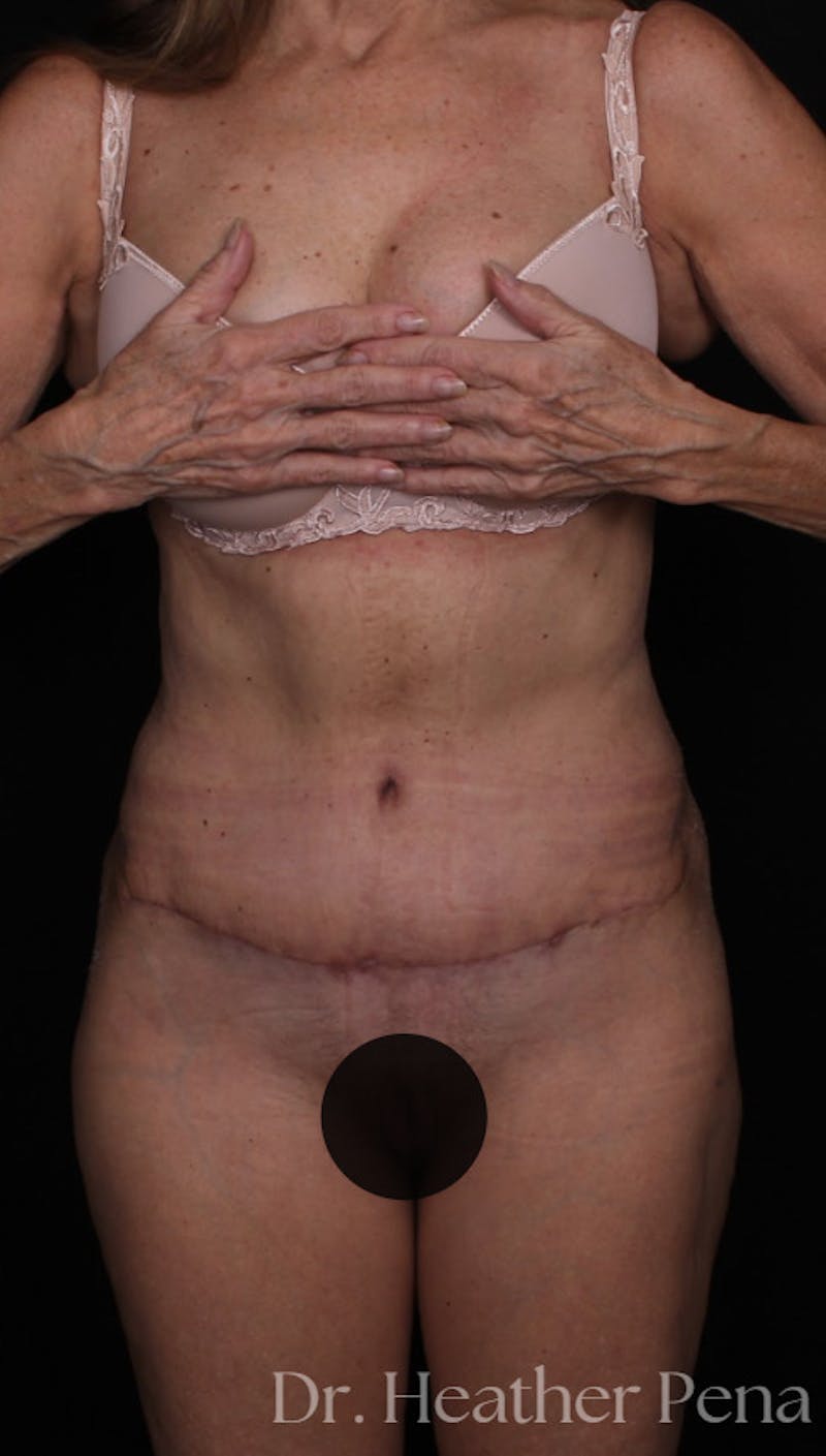 Abdominoplasty Before & After Gallery - Patient 319384 - Image 4
