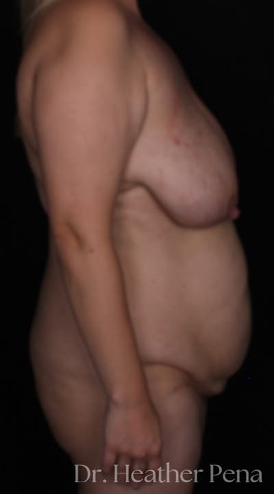Abdominoplasty Before & After Gallery - Patient 281727 - Image 1