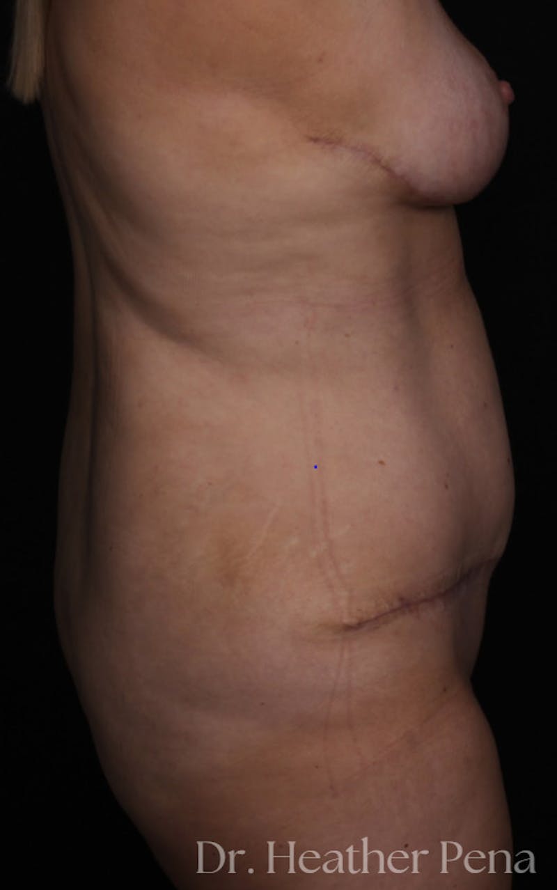 Abdominoplasty Before & After Gallery - Patient 281727 - Image 2