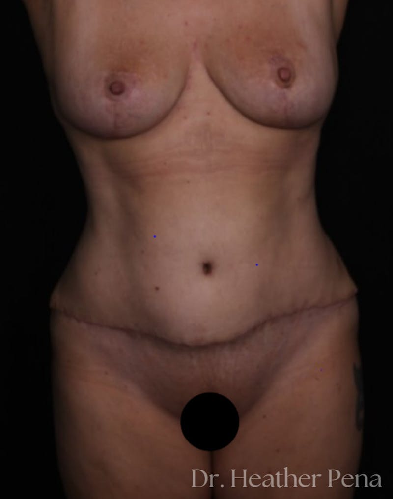 Abdominoplasty Before & After Gallery - Patient 281727 - Image 4