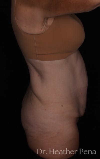 Abdominoplasty Before & After Gallery - Patient 241902 - Image 1
