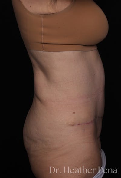 Abdominoplasty Before & After Gallery - Patient 241902 - Image 2