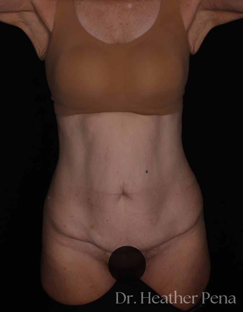 Abdominoplasty Before & After Gallery - Patient 241902 - Image 3