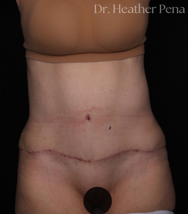 Abdominoplasty Before & After Gallery - Patient 241902 - Image 4