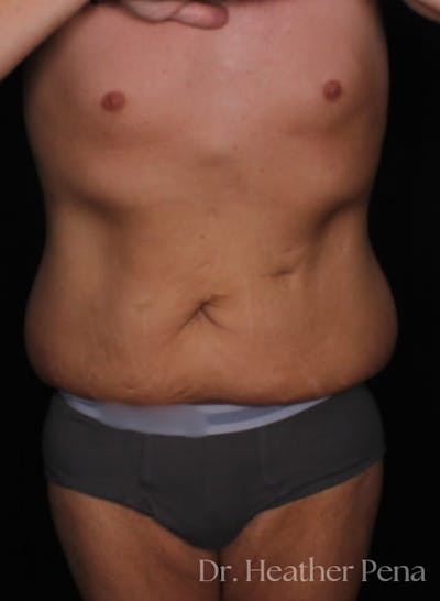 Abdominoplasty Before & After Gallery - Patient 209398 - Image 1