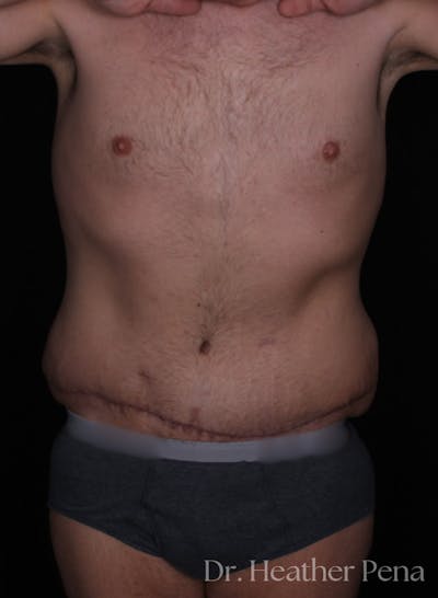 Abdominoplasty Before & After Gallery - Patient 209398 - Image 2