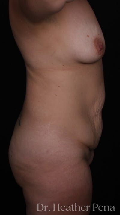 Abdominoplasty Before & After Gallery - Patient 115593 - Image 1