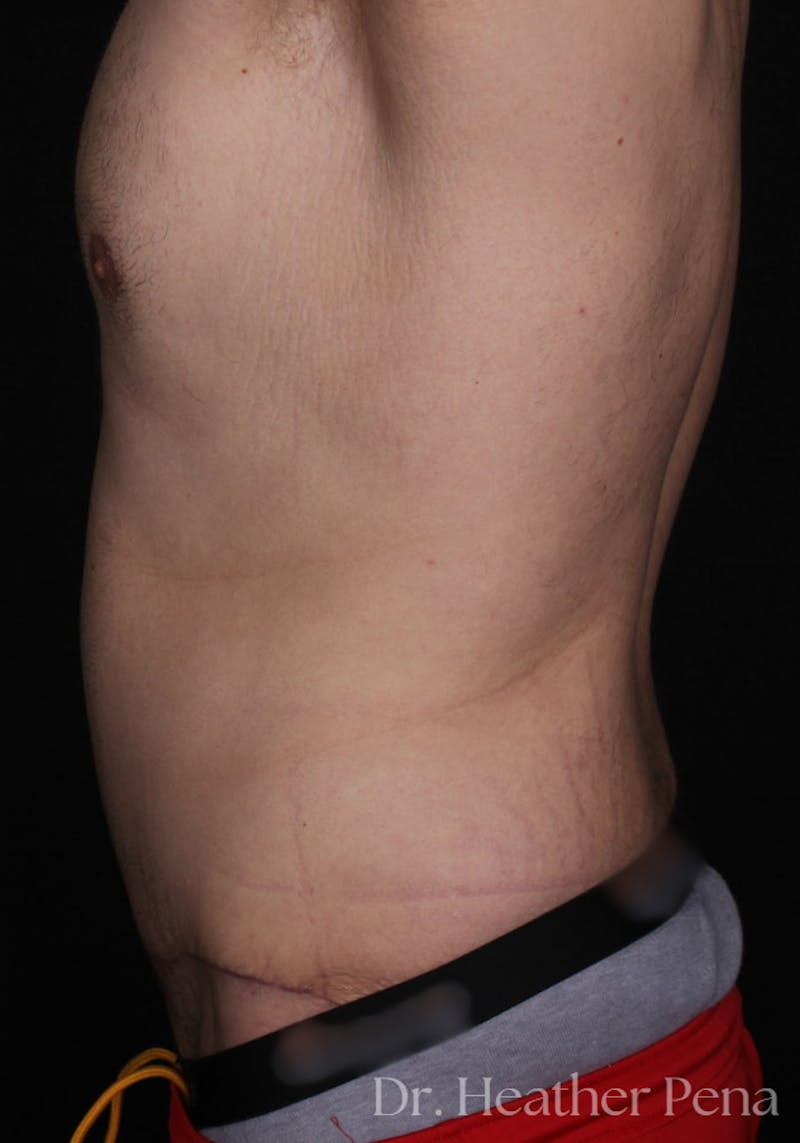 Abdominoplasty Before & After Gallery - Patient 164010 - Image 4