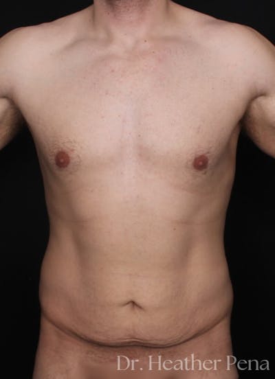 Abdominoplasty Before & After Gallery - Patient 164010 - Image 1