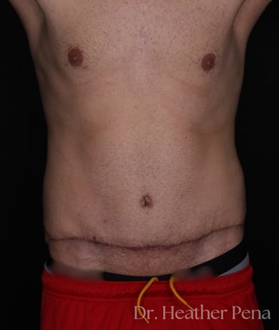 Abdominoplasty Before & After Gallery - Patient 164010 - Image 2