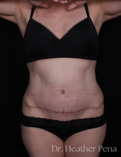 Abdominoplasty Before & After Gallery - Patient 380260 - Image 2