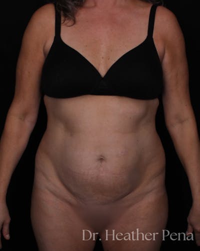 Abdominoplasty Before & After Gallery - Patient 380260 - Image 1