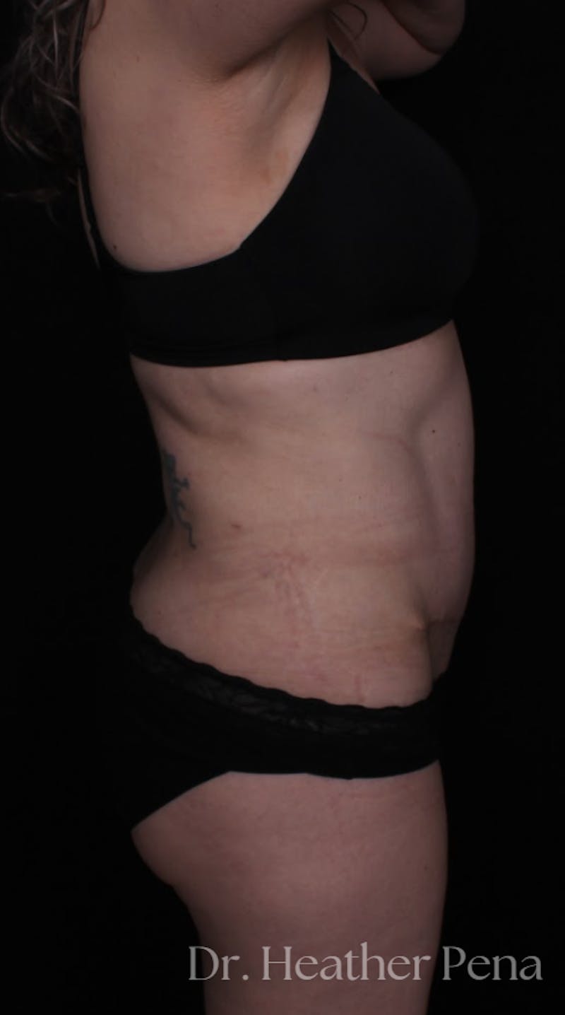 Abdominoplasty Before & After Gallery - Patient 380260 - Image 4