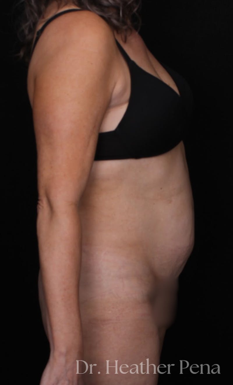 Abdominoplasty Before & After Gallery - Patient 380260 - Image 3