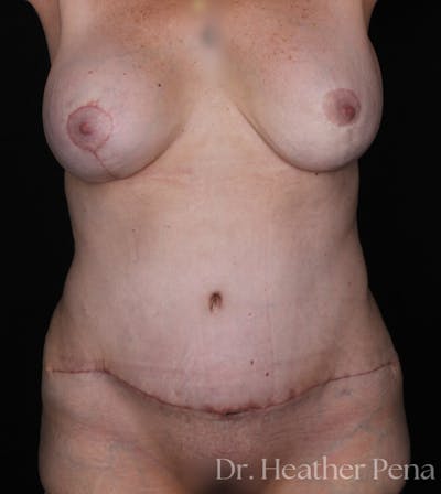 Abdominoplasty Before & After Gallery - Patient 164587 - Image 2