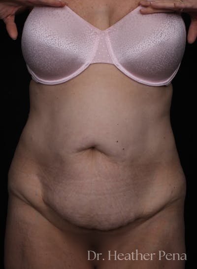 Abdominoplasty Before & After Gallery - Patient 164587 - Image 1