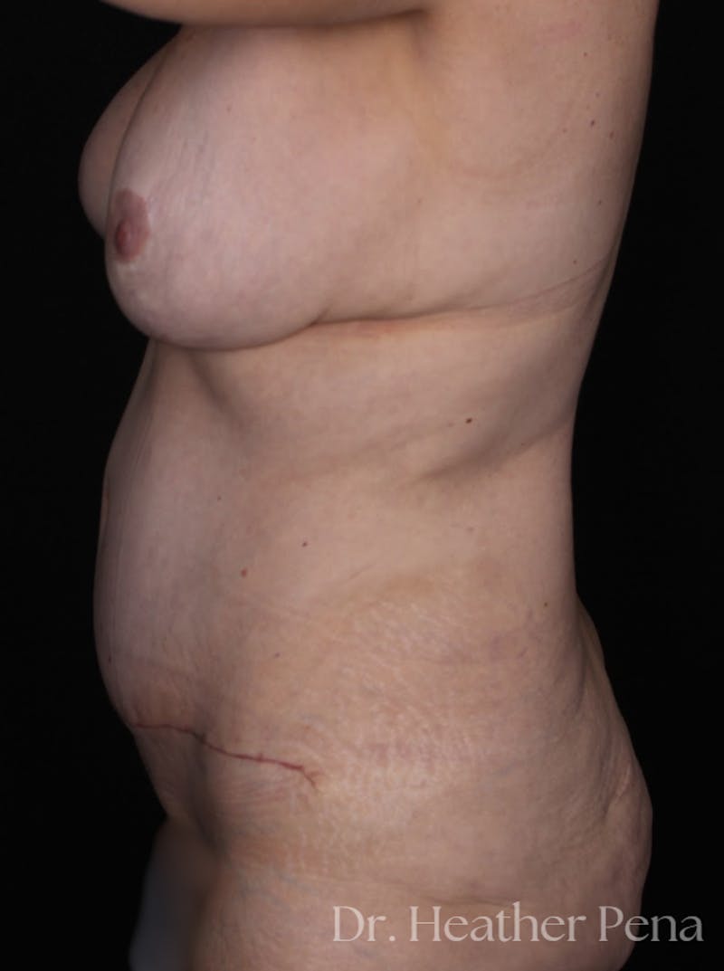 Abdominoplasty Before & After Gallery - Patient 164587 - Image 4