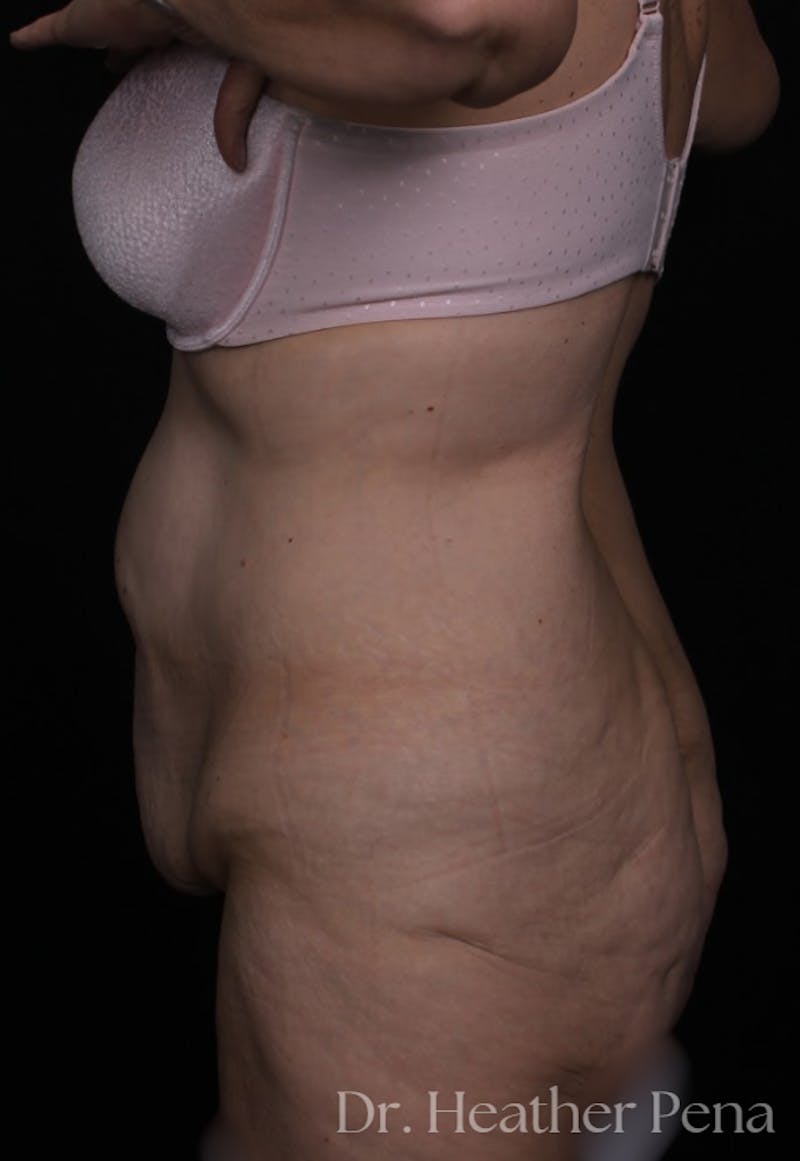 Abdominoplasty Before & After Gallery - Patient 164587 - Image 3