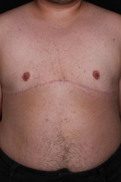 FTM Top Surgery Before & After Gallery - Patient 388651 - Image 2