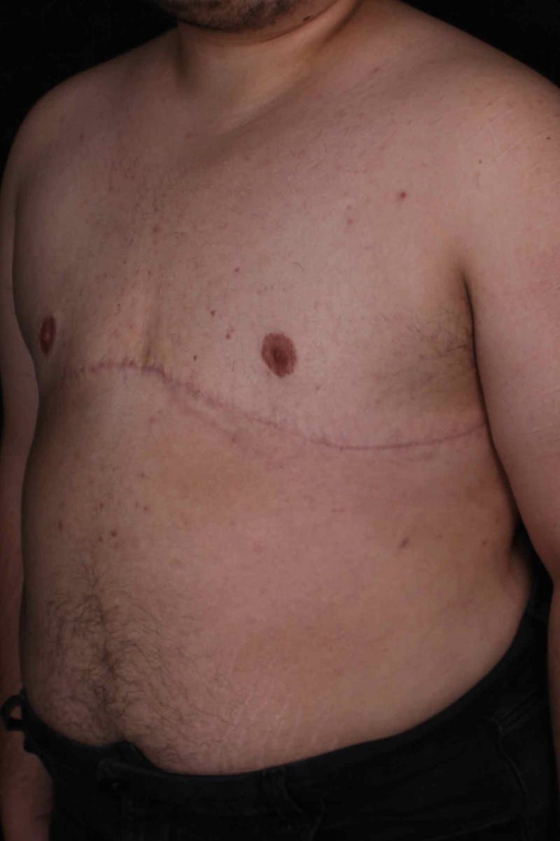 FTM Top Surgery Before & After Gallery - Patient 388651 - Image 6