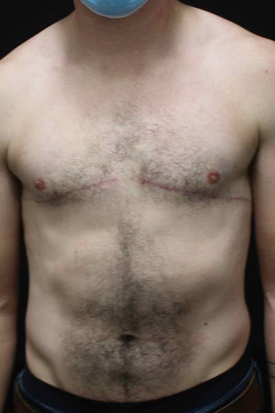 FTM Top Surgery Before & After Gallery - Patient 165364 - Image 2