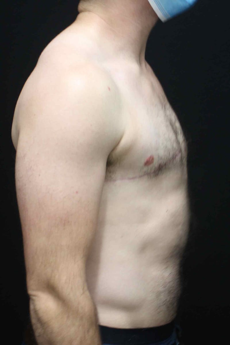 FTM Top Surgery Before & After Gallery - Patient 165364 - Image 4