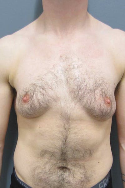 FTM Top Surgery Before & After Gallery - Patient 165364 - Image 1