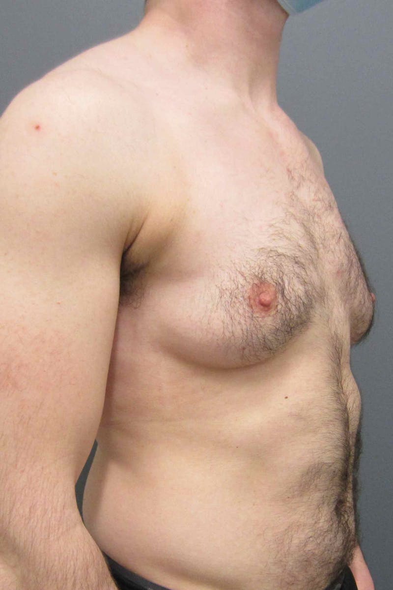 FTM Top Surgery Before & After Gallery - Patient 165364 - Image 3