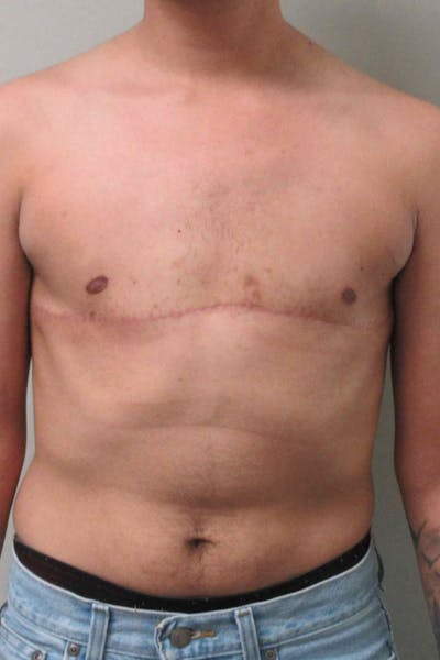 FTM Top Surgery Before & After Gallery - Patient 934823 - Image 2