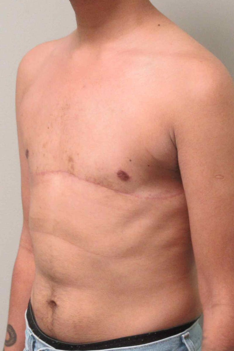 FTM Top Surgery Before & After Gallery - Patient 934823 - Image 4