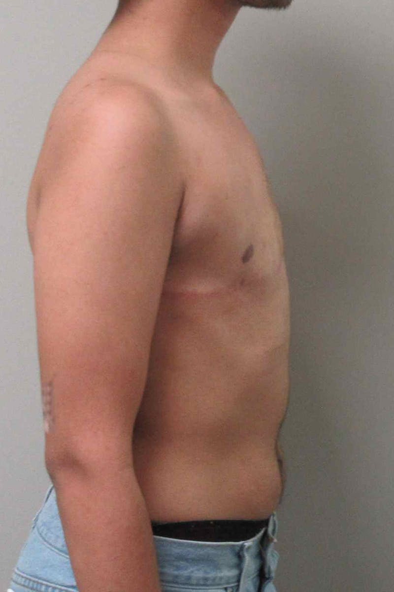 FTM Top Surgery Before & After Gallery - Patient 934823 - Image 6