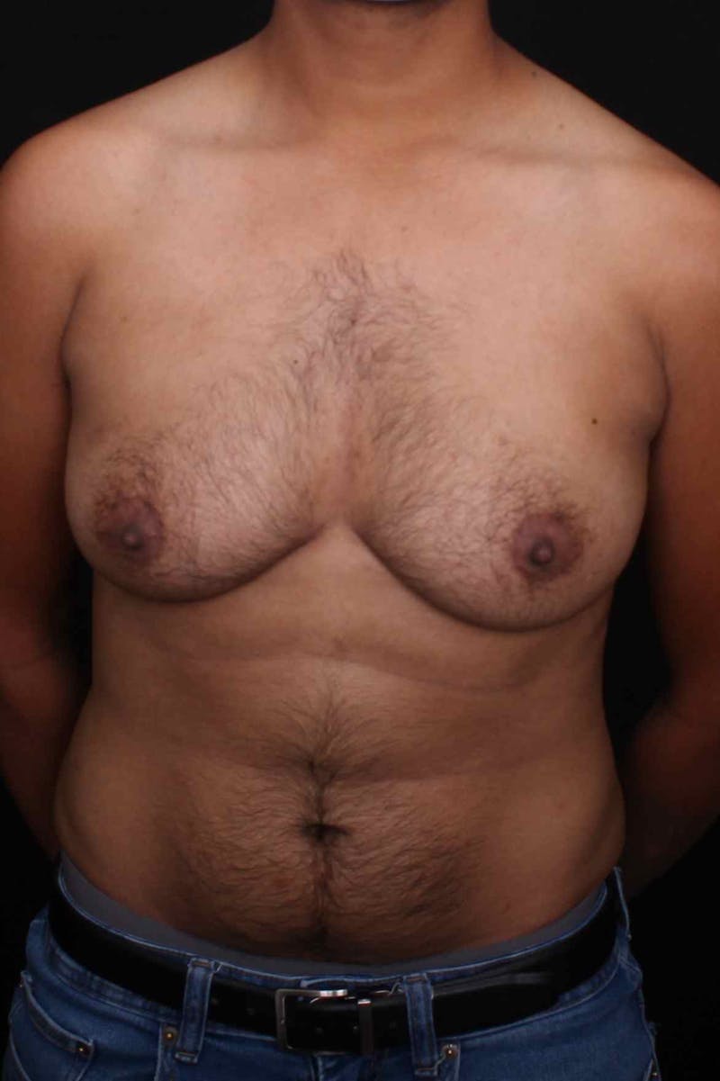 FTM Top Surgery Before & After Gallery - Patient 934823 - Image 1