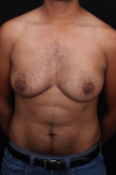 FTM Top Surgery Before & After Gallery - Patient 934823 - Image 1