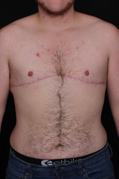 FTM Top Surgery Before & After Gallery - Patient 297266 - Image 2